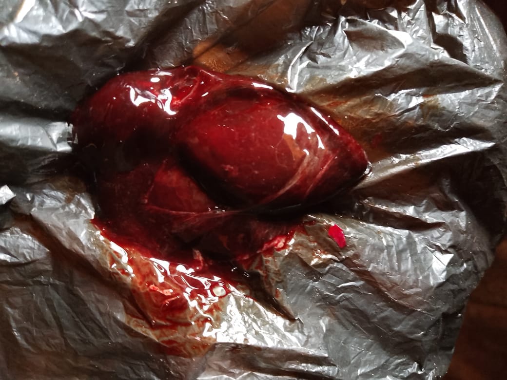 FIBROID